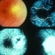 Blastomycosis Blastomycosis